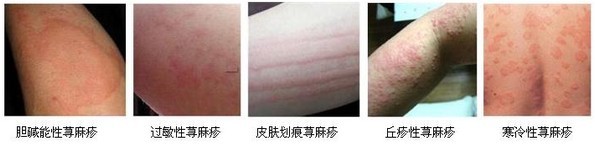 原因      4月5日上午,四川初三学生严雅欣(化名)受寒后,全身起风团